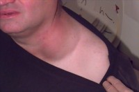 Photo of tumor on Nicks neck.